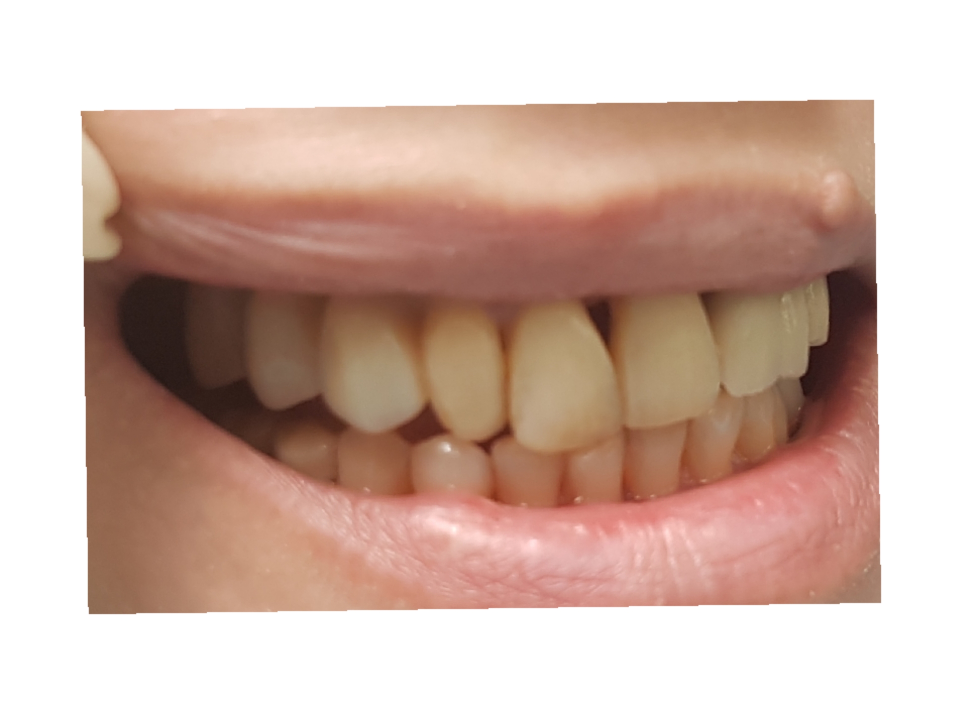 Dental Implants | Malvern East Dental